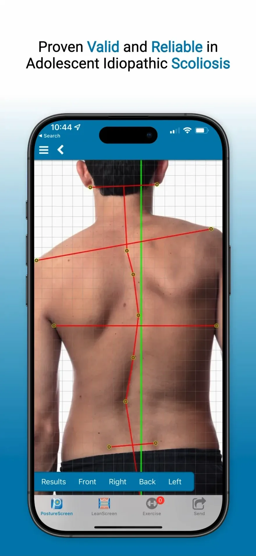 Proven Valid and Reliable in Adolescent Idiopathic Scoliosis