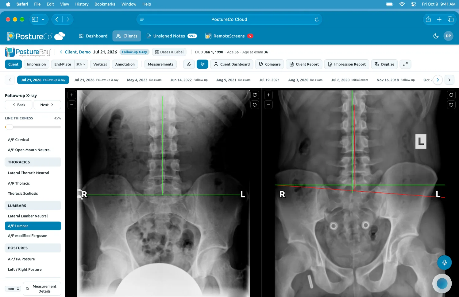 PostureCo Cloud preview, coming soon: two lumbar X-ray views from PostureRay side by side in a demo client's record, with the client's other views listed beside them.