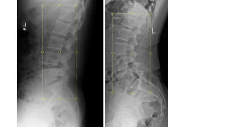 A second pair of lateral cervical X-rays with computer vision landmark points for the clinician to review.